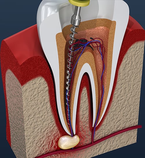 Root Canal Treatment